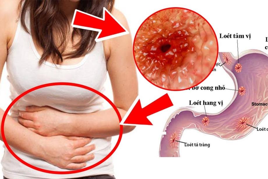  Bạn Có Đang Bỏ Qua Các Dấu Hiệu Sớm Của Viêm Loét Dạ Dày?